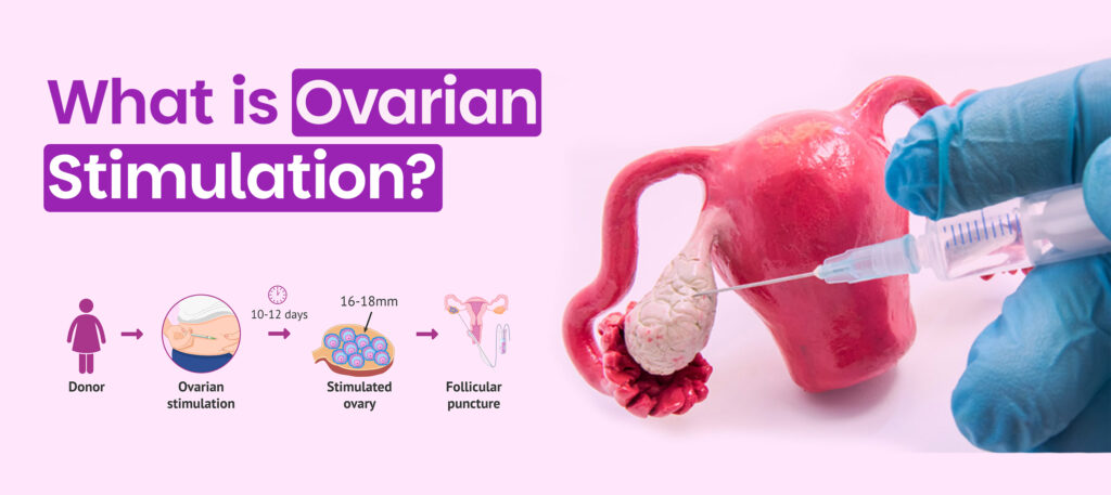 Ovarian stimulation process in IVF treatment – donor, hormone injections, stimulated ovaries, and follicular puncture explained with medical illustration.